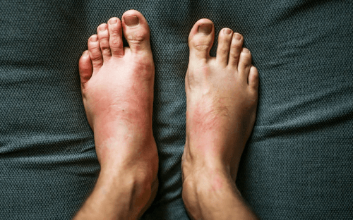 Physiotherapy for ICU-Acquired or General Weakness