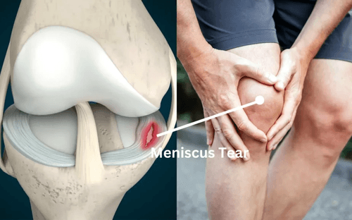 Ortho physiotherapy for ACL, PCL, Meniscal Tear, Post-Reconstruction